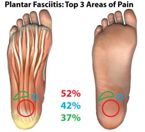 Plantar Fasciitis Top Areas of Pain