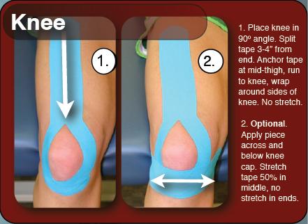 How to tape for Runner's Knee