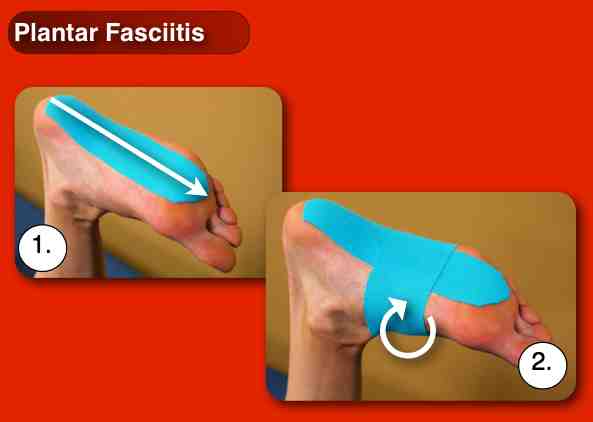 Plantar Fasciitis kinesiology taping instructions