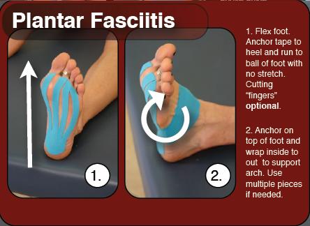 Plantar Fasciitis kinesiology taping instructions