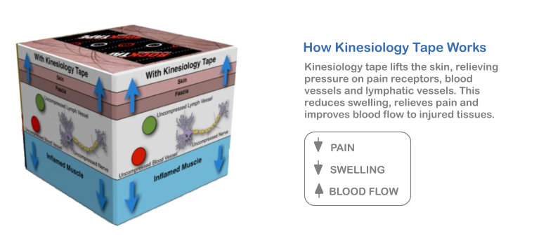 How Kinesiology Tape Relieves Swelling and Edema