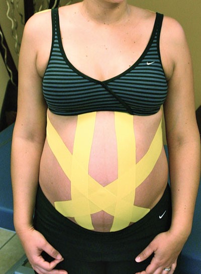 A kinesiology tape “baby belt” application, designed to provide support for the abdomen & relieve discomfort in the lower back and abdominal areas.
