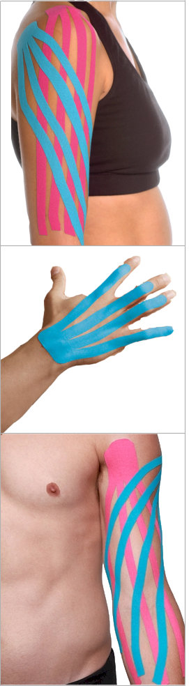 Examples of Kinesiology Taping for Lymphedema