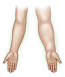 lymphedema-arms