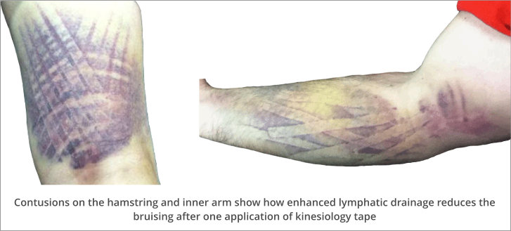 How kinesiology tape reduces bruising