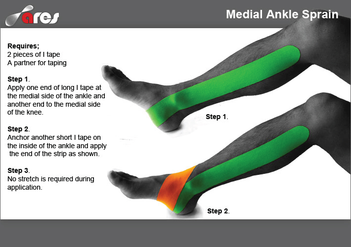 Medial-Ankle-Sprain1
