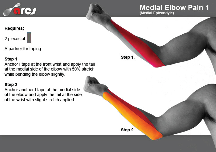 Medial-Elbow-Pain-1