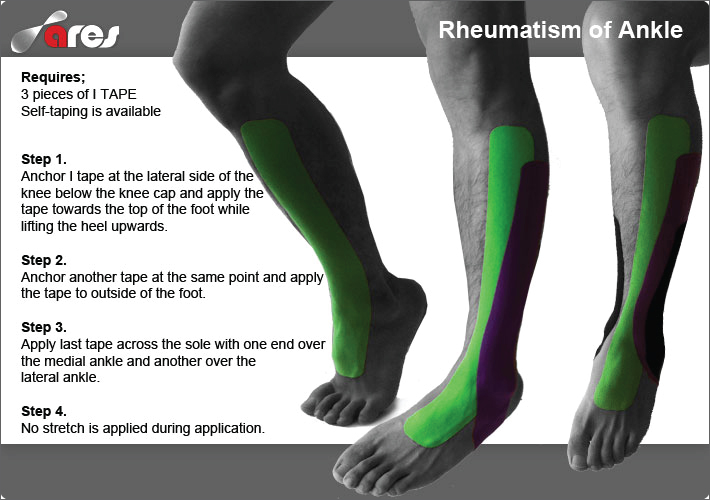 Rheumatism-of-Ankle1