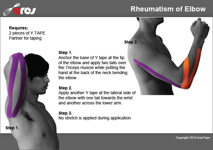 Rheumatism-of-Elbow-Treatment