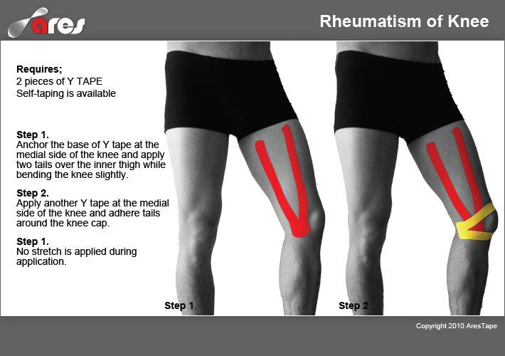 Rheumatism-of-Knee