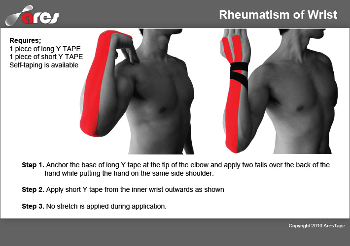 Rheumatism-of-Wrist-treatment