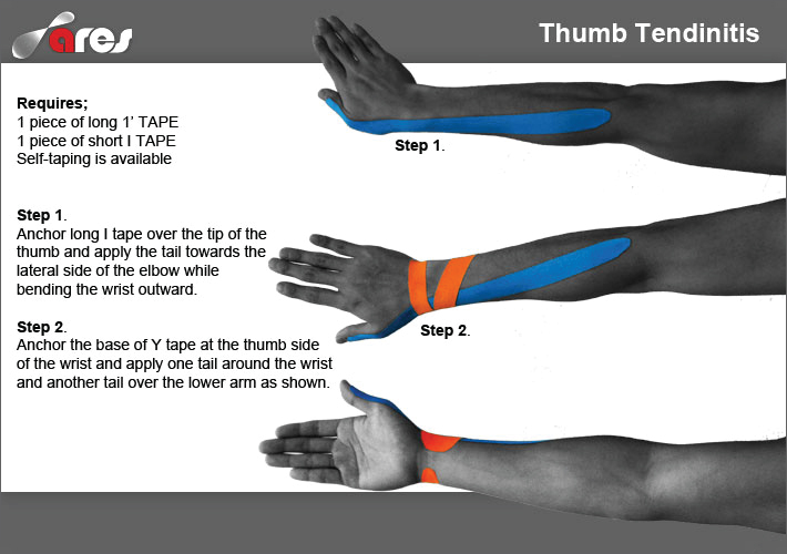 Thumb-Tendinitis-treatment